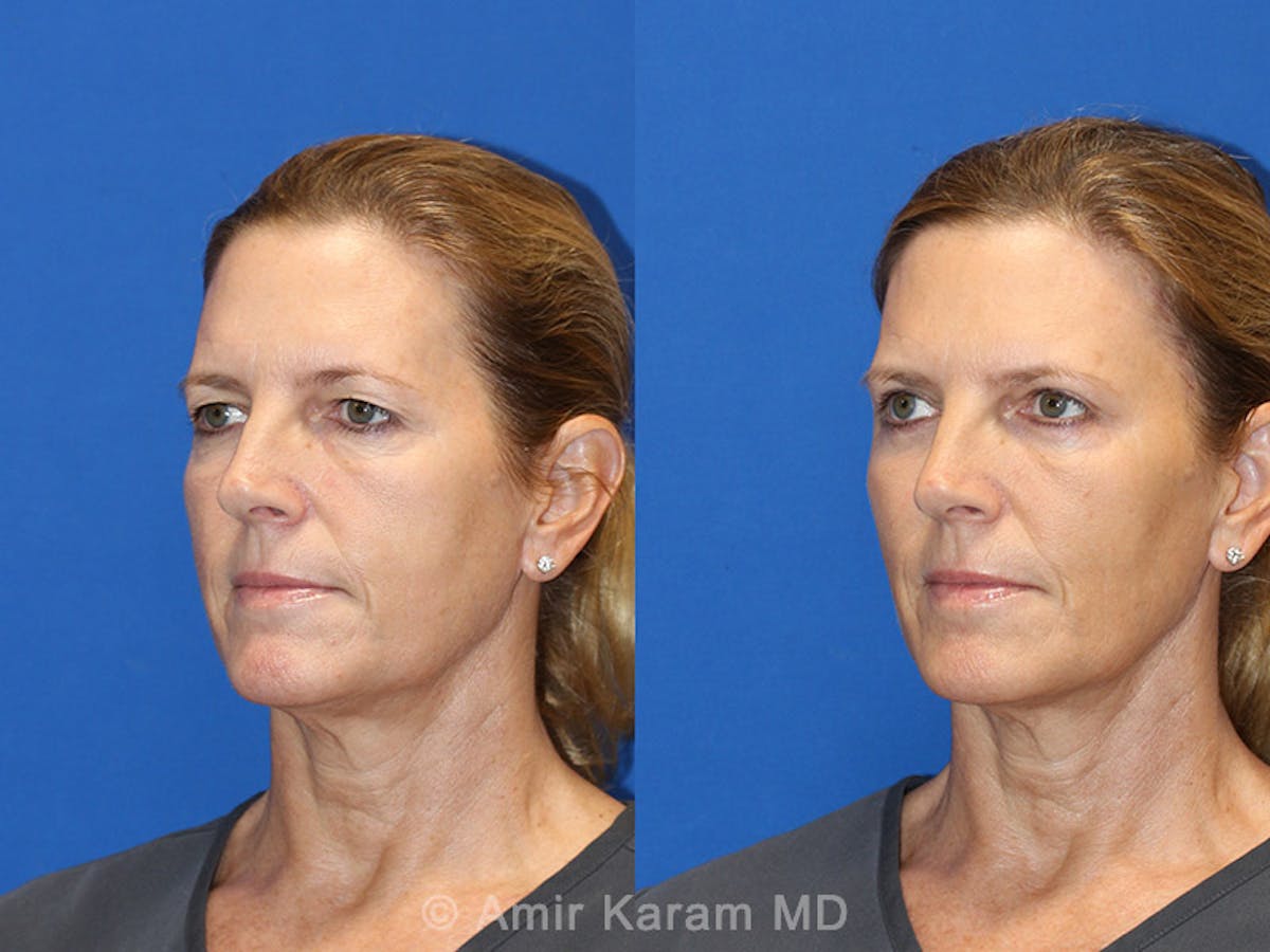 Fat Transfer Before & After Gallery - Patient 71700741 - Image 2