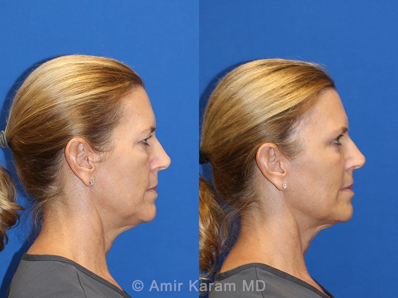 Fat Transfer Before & After Gallery - Patient 71700741 - Image 3