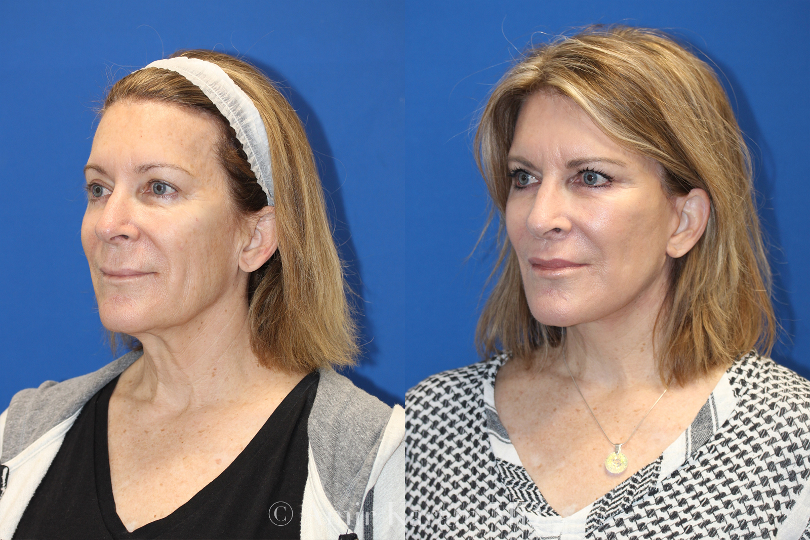 Patient 71700742 Vertical Restore® / Facial Rejuvenation Before