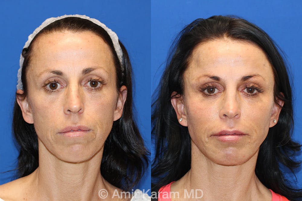 Vertical Restore® / Facial Rejuvenation Before & After Gallery - Patient 71700752 - Image 1