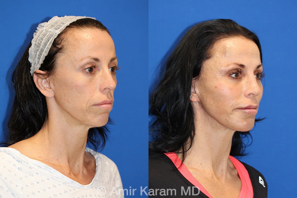 Vertical Restore® / Facial Rejuvenation Before & After Gallery - Patient 71700752 - Image 2