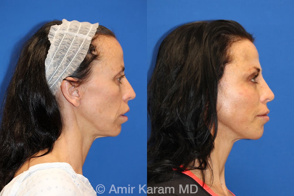 Vertical Restore® / Facial Rejuvenation Before & After Gallery - Patient 71700752 - Image 3