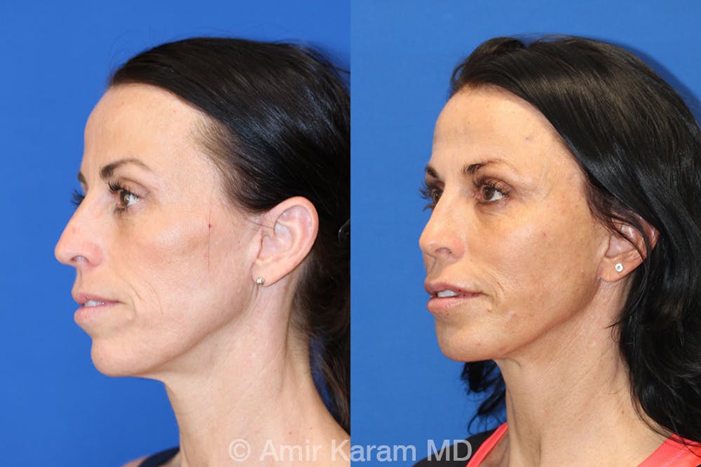 Vertical Restore® / Facial Rejuvenation Before & After Gallery - Patient 71700752 - Image 4