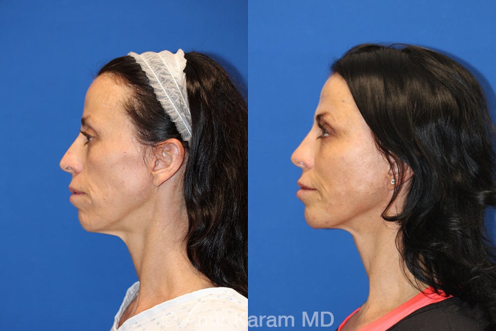Vertical Restore® / Facial Rejuvenation Before & After Gallery - Patient 71700752 - Image 5