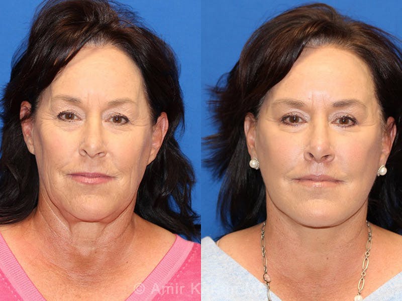 Vertical Restore® / Facial Rejuvenation Before & After Gallery - Patient 71700758 - Image 1