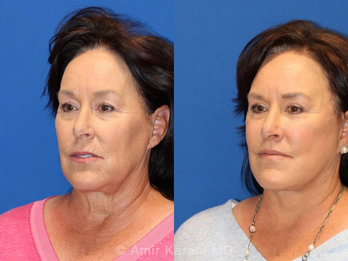 Vertical Restore® / Facial Rejuvenation Before & After Gallery - Patient 71700758 - Image 2