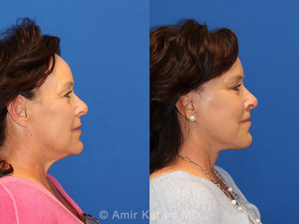 Vertical Restore® / Facial Rejuvenation Before & After Gallery - Patient 71700758 - Image 3