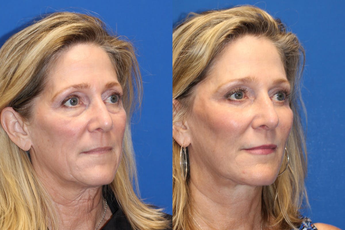 Fat Transfer Before & After Gallery - Patient 71700764 - Image 2