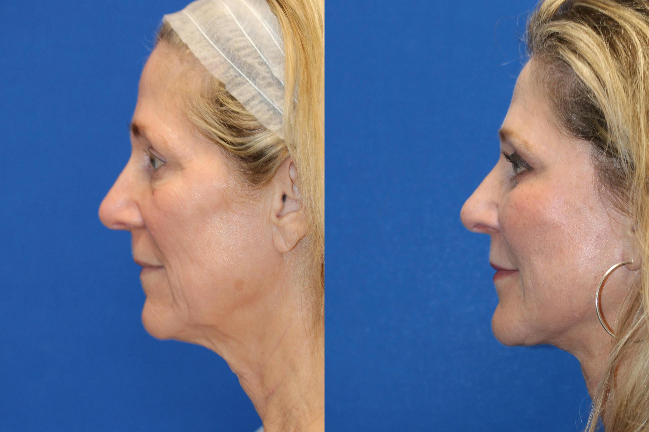 Fat Transfer Before & After Gallery - Patient 71700764 - Image 3