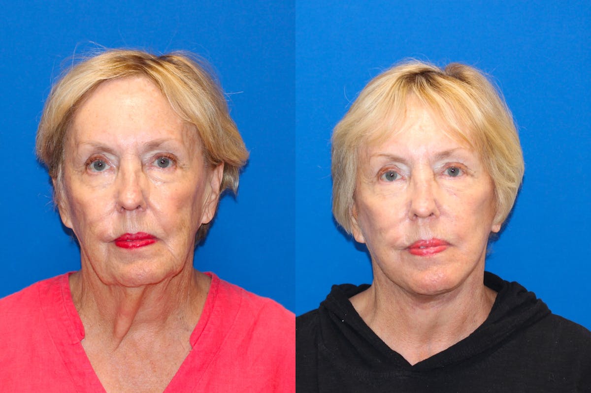 Vertical Restore® / Facial Rejuvenation Before & After Gallery - Patient 71700768 - Image 1