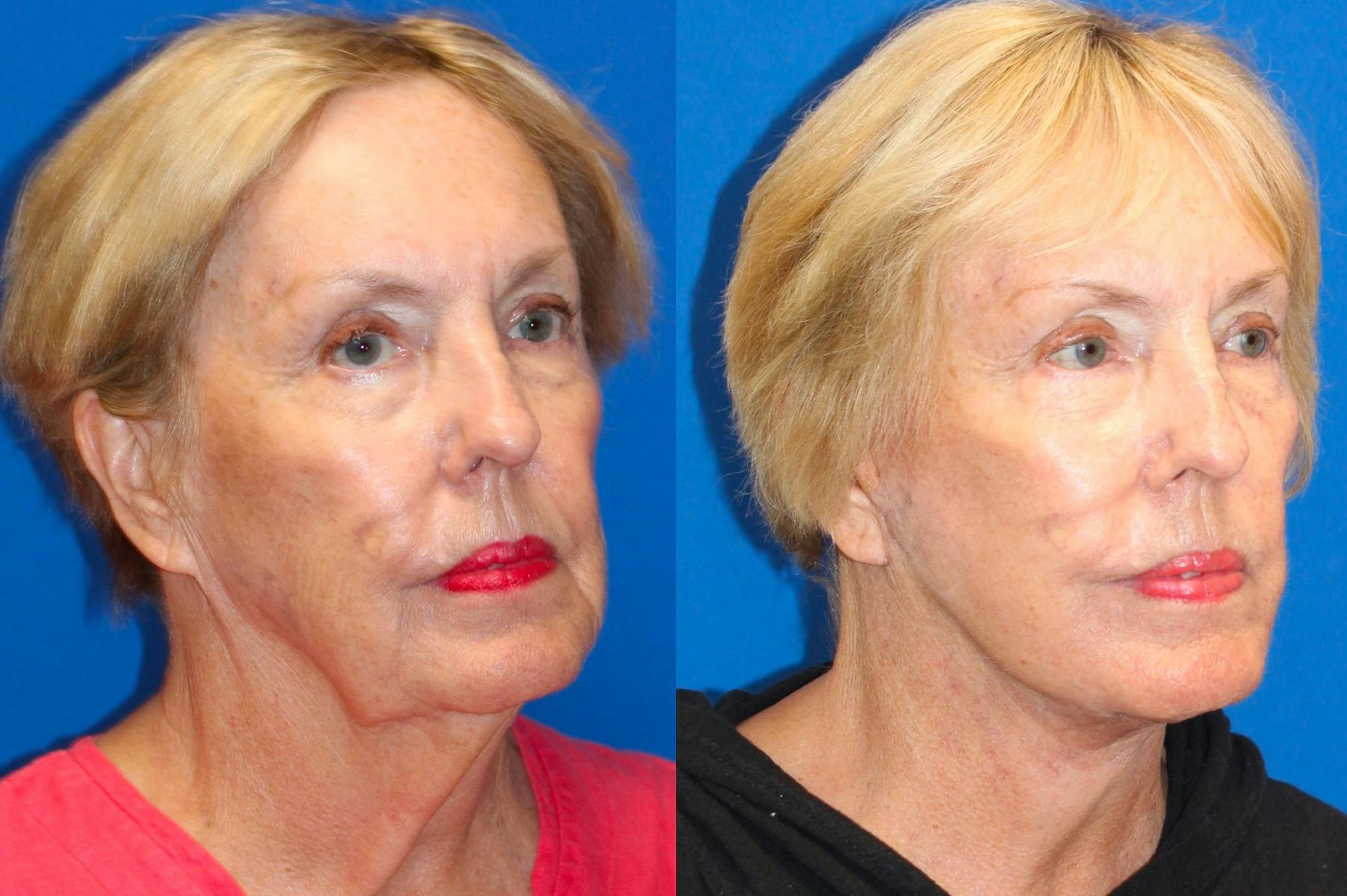 Vertical Restore® / Facial Rejuvenation Before & After Gallery - Patient 71700768 - Image 2