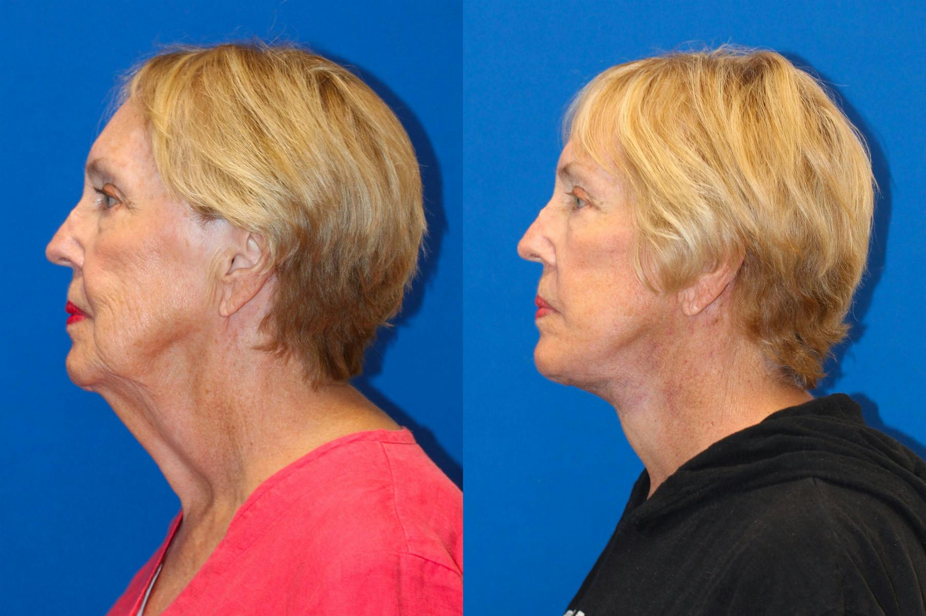 Vertical Restore® / Facial Rejuvenation Before & After Gallery - Patient 71700768 - Image 3