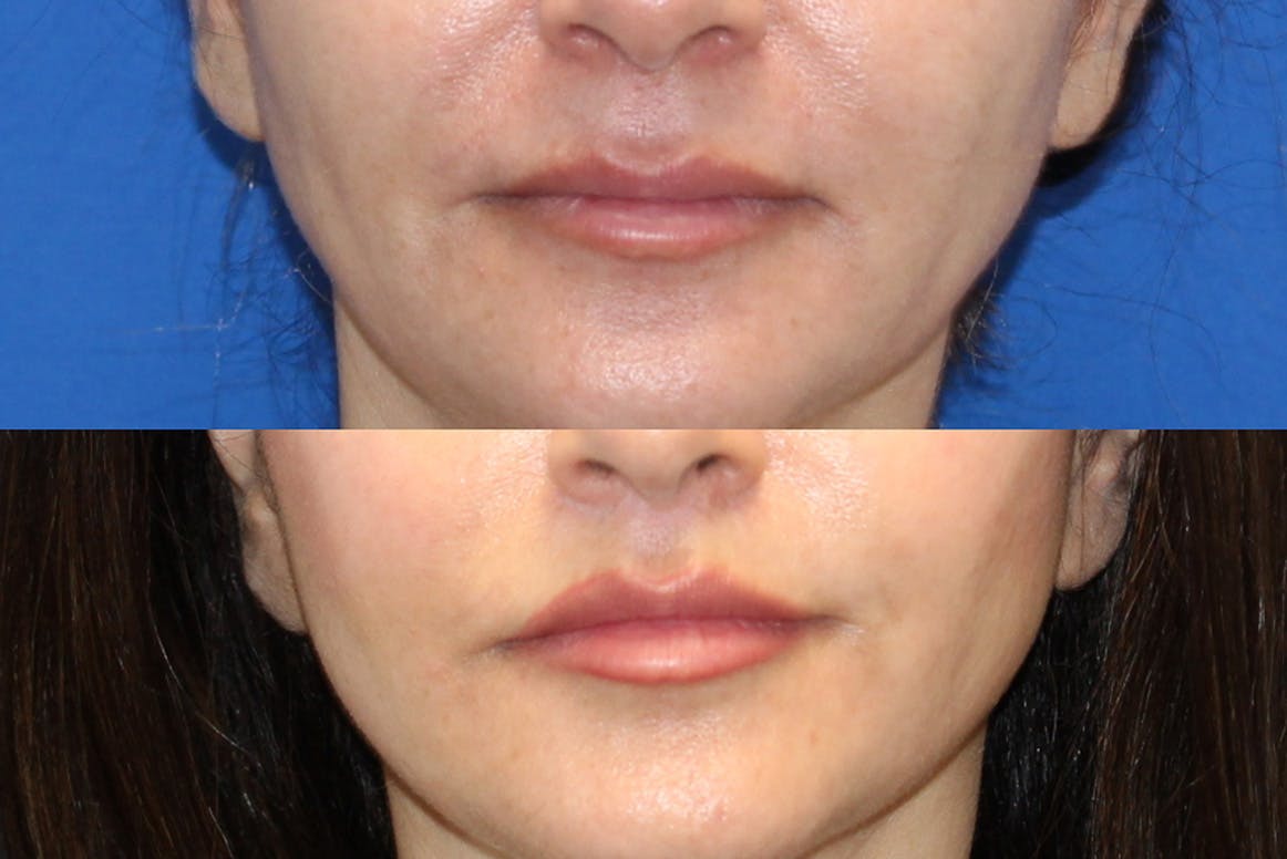 Lip Lift Before & After Gallery - Patient 71700770 - Image 1