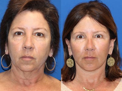 Vertical Restore® / Facial Rejuvenation Before & After Gallery - Patient 71700805 - Image 1