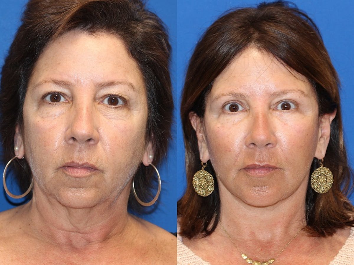 Vertical Restore® / Facial Rejuvenation Before & After Gallery - Patient 71700805 - Image 1