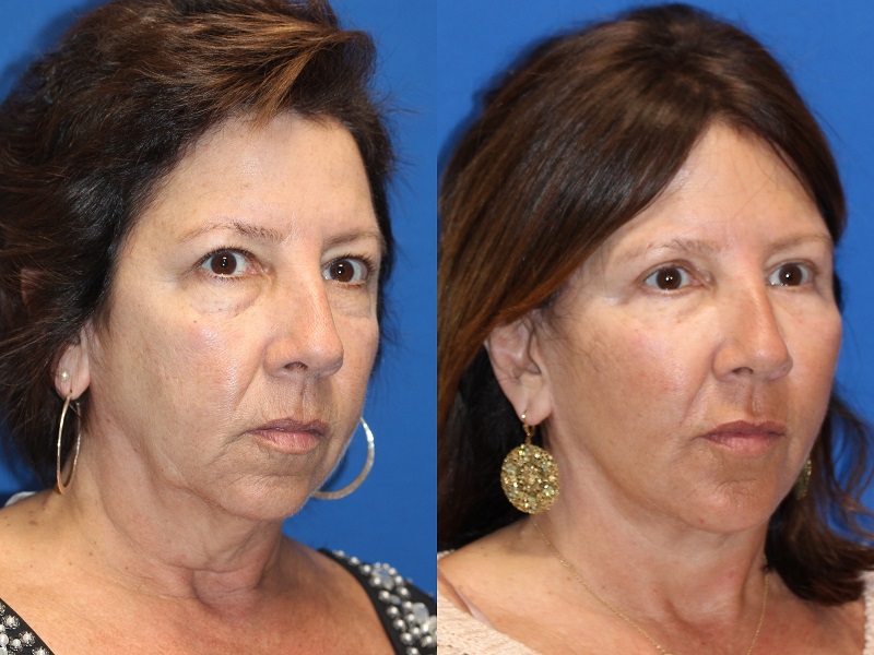 Patient 71700805 Vertical Restore® / Facial Rejuvenation Before