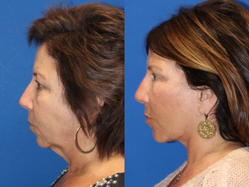 Vertical Restore® / Facial Rejuvenation Before & After Gallery - Patient 71700805 - Image 4