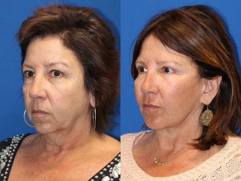 Vertical Restore® / Facial Rejuvenation Before & After Gallery - Patient 71700805 - Image 5