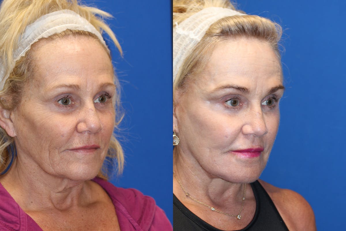 Fat Transfer Before & After Gallery - Patient 71700816 - Image 2