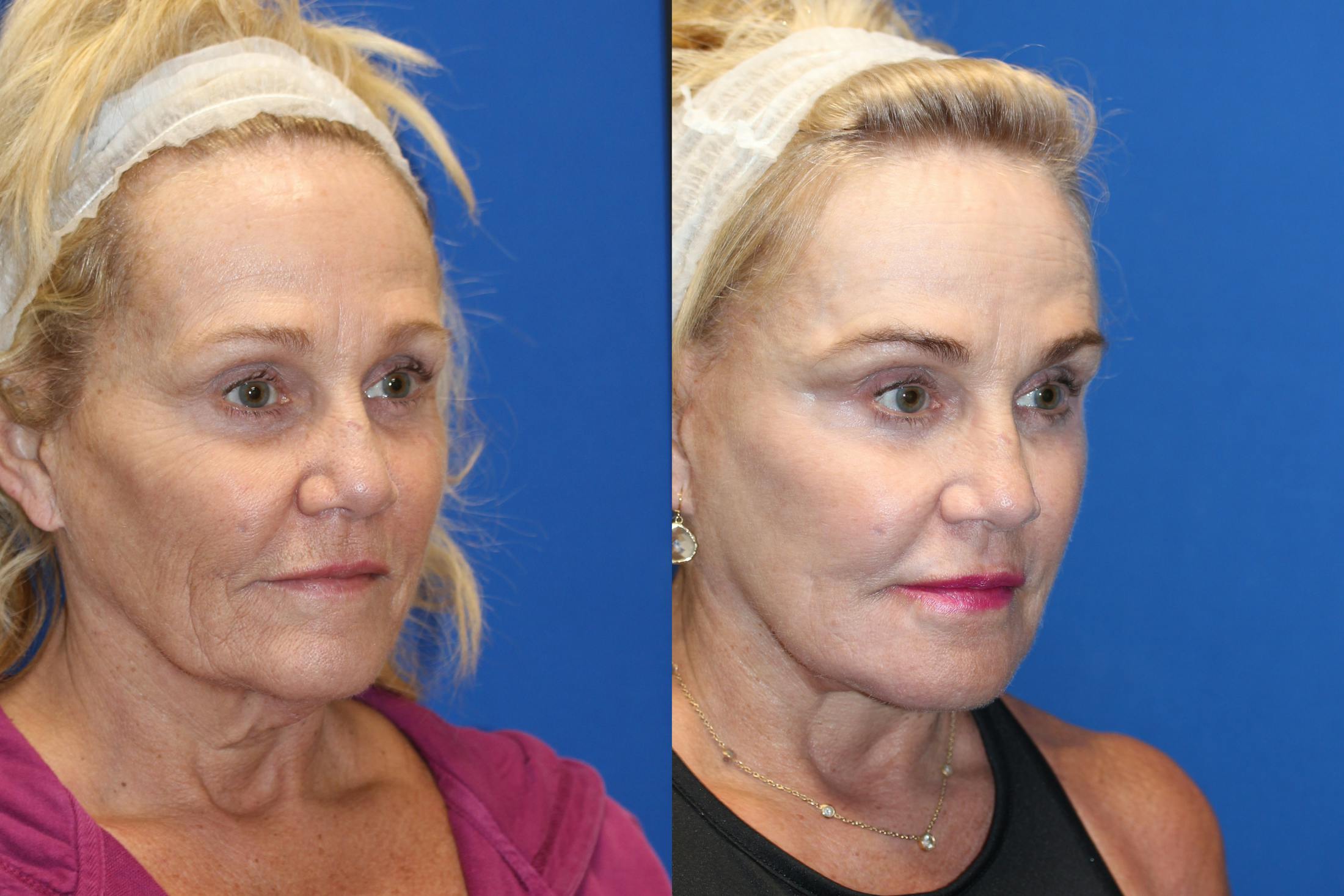 Fat Transfer Before & After Gallery - Patient 71700816 - Image 2