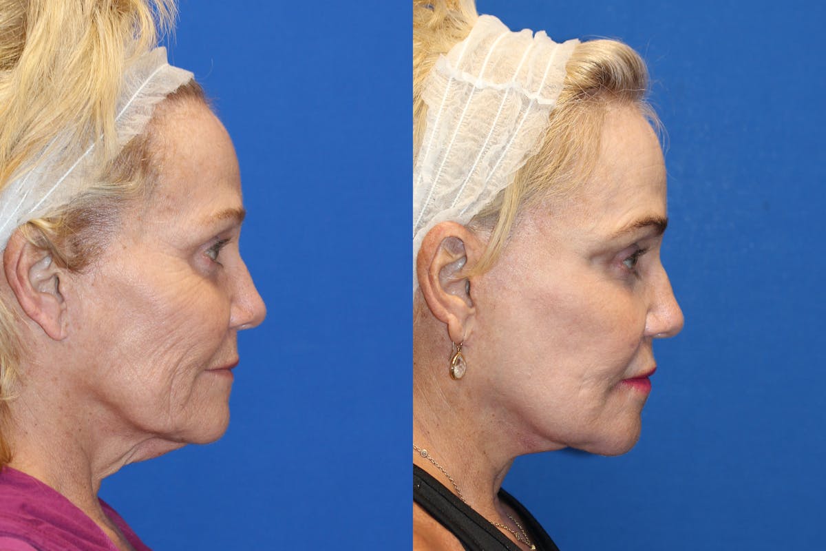 Fat Transfer Before & After Gallery - Patient 71700816 - Image 3