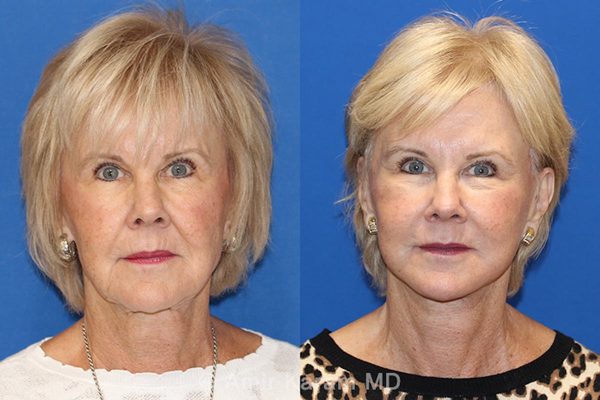 Vertical Restore® / Facial Rejuvenation Before & After Gallery - Patient 71700819 - Image 1