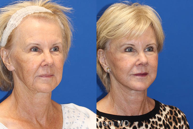 Vertical Restore® / Facial Rejuvenation Before & After Gallery - Patient 71700819 - Image 2