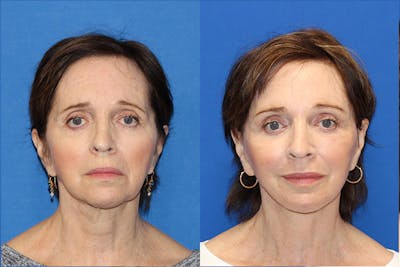 Fat Transfer Before & After Gallery - Patient 71701124 - Image 1
