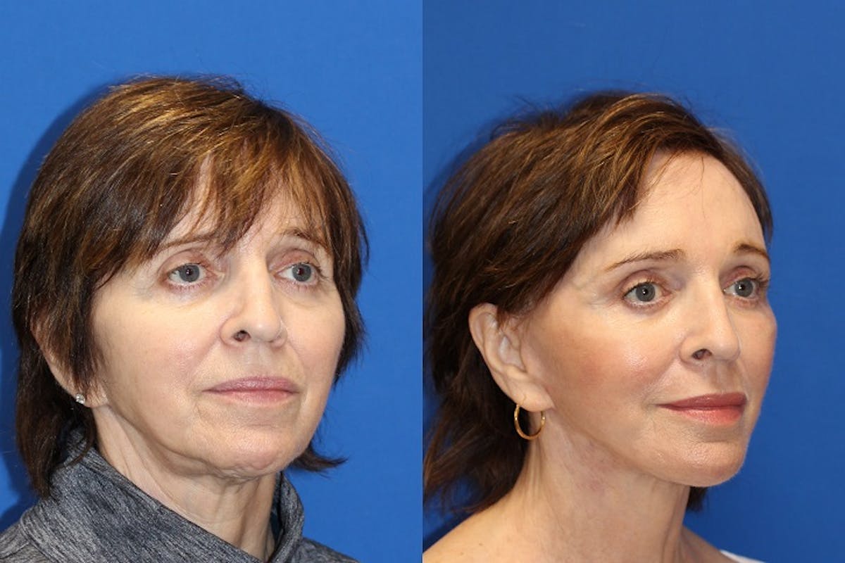 Fat Transfer Before & After Gallery - Patient 71701124 - Image 2
