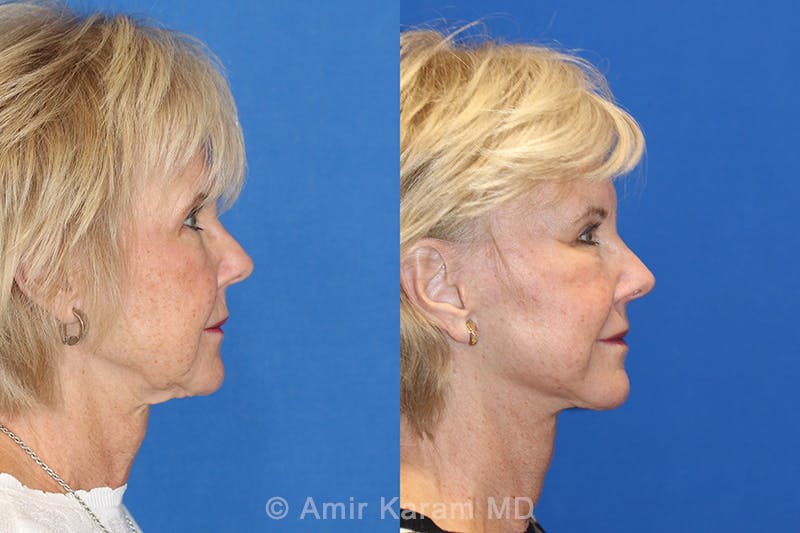 Vertical Restore® / Facial Rejuvenation Before & After Gallery - Patient 71700819 - Image 3