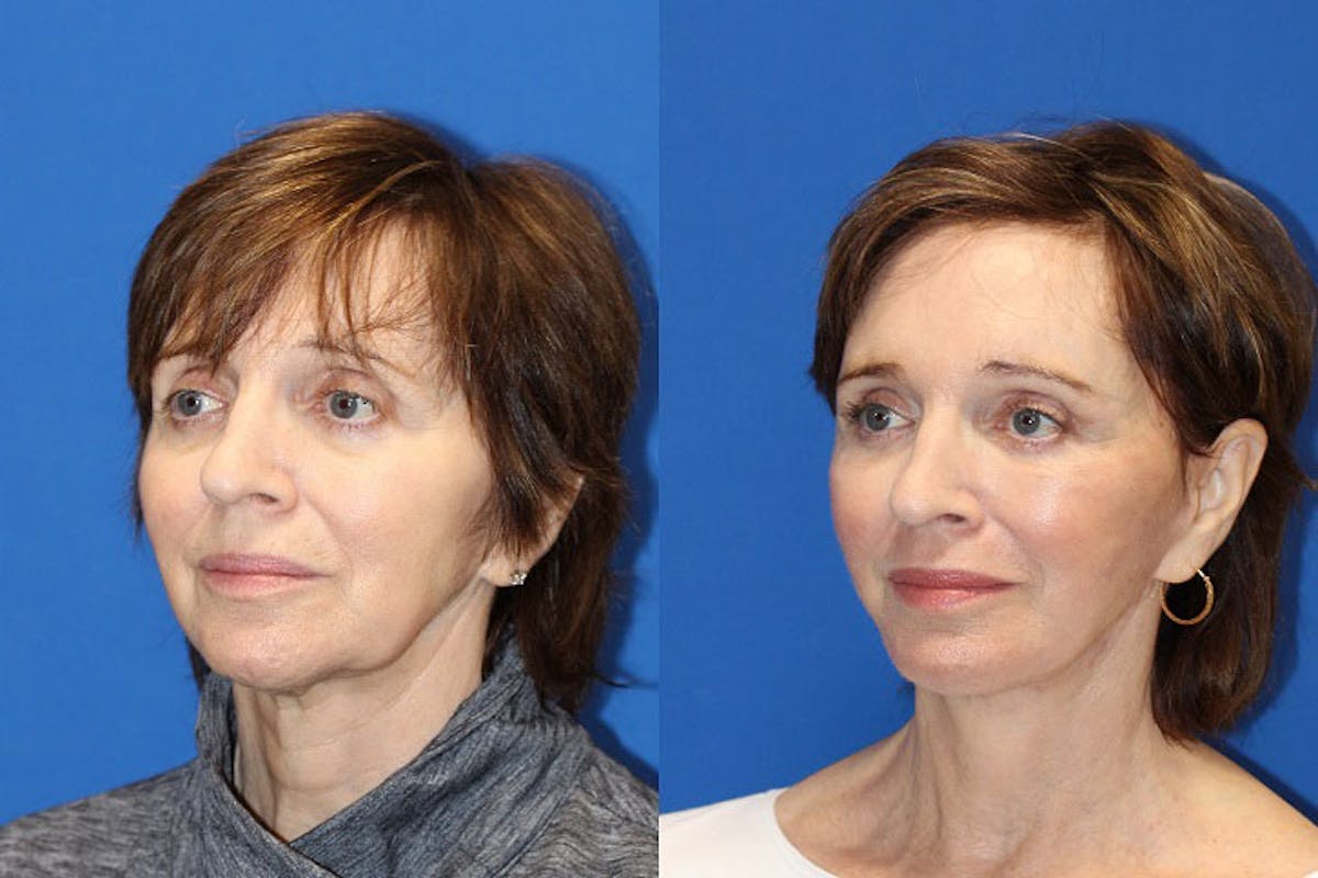 Fat Transfer Before & After Gallery - Patient 71701124 - Image 3
