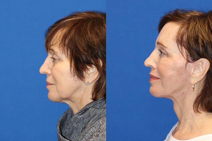 Fat Transfer Before & After Gallery - Patient 71701124 - Image 4