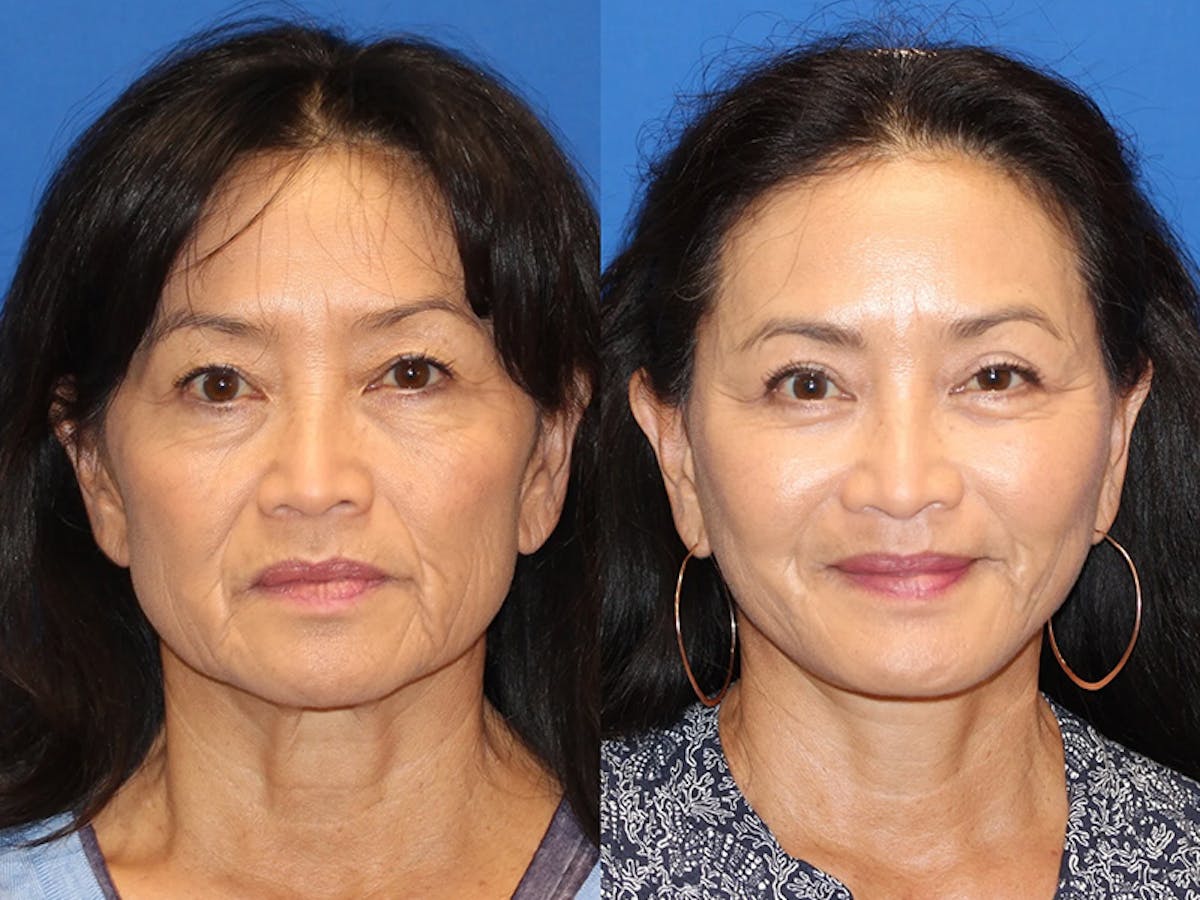 Fat Transfer Before & After Gallery - Patient 71701273 - Image 1