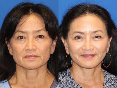 Fat Transfer Before & After Gallery - Patient 71701273 - Image 1