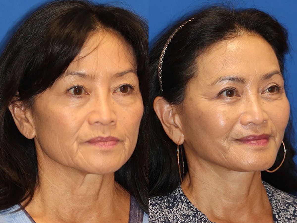 Fat Transfer Before & After Gallery - Patient 71701273 - Image 2