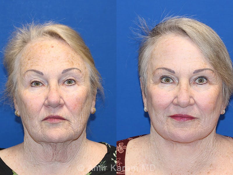 Vertical Restore® / Facial Rejuvenation Before & After Gallery - Patient 71701275 - Image 1