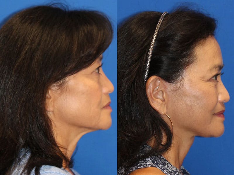 Fat Transfer Before & After Gallery - Patient 71701273 - Image 3