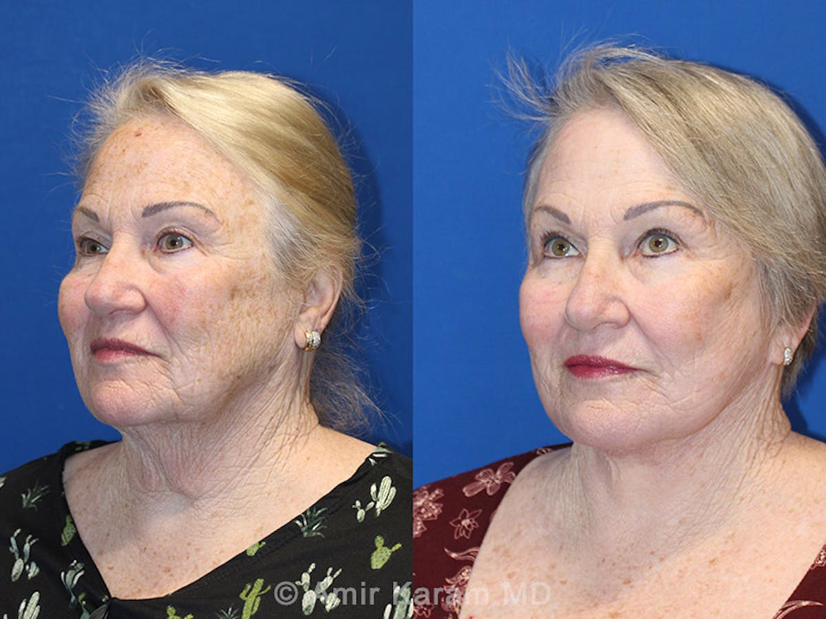 Vertical Restore® / Facial Rejuvenation Before & After Gallery - Patient 71701275 - Image 2
