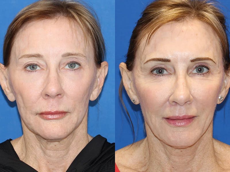 Patient 89289860 Fat Transfer Before & After Photos Carmel Valley