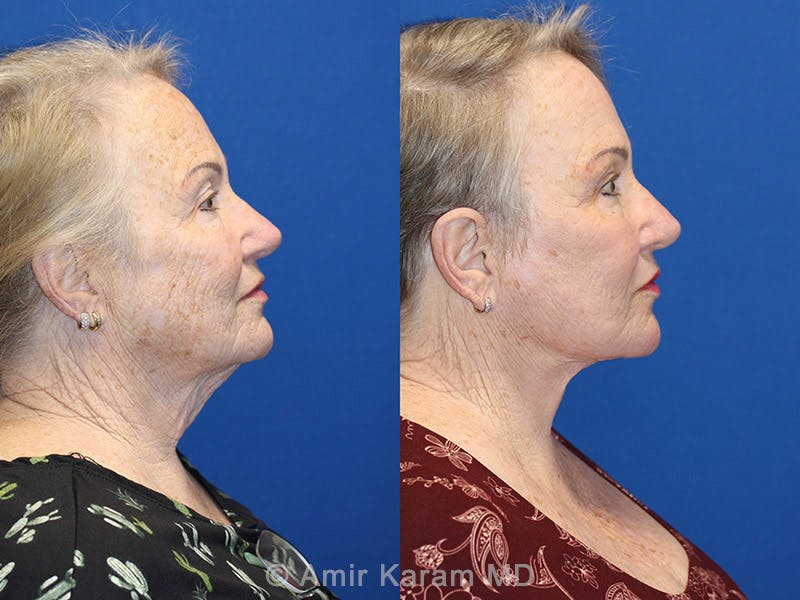 Vertical Restore® / Facial Rejuvenation Before & After Gallery - Patient 71701275 - Image 3