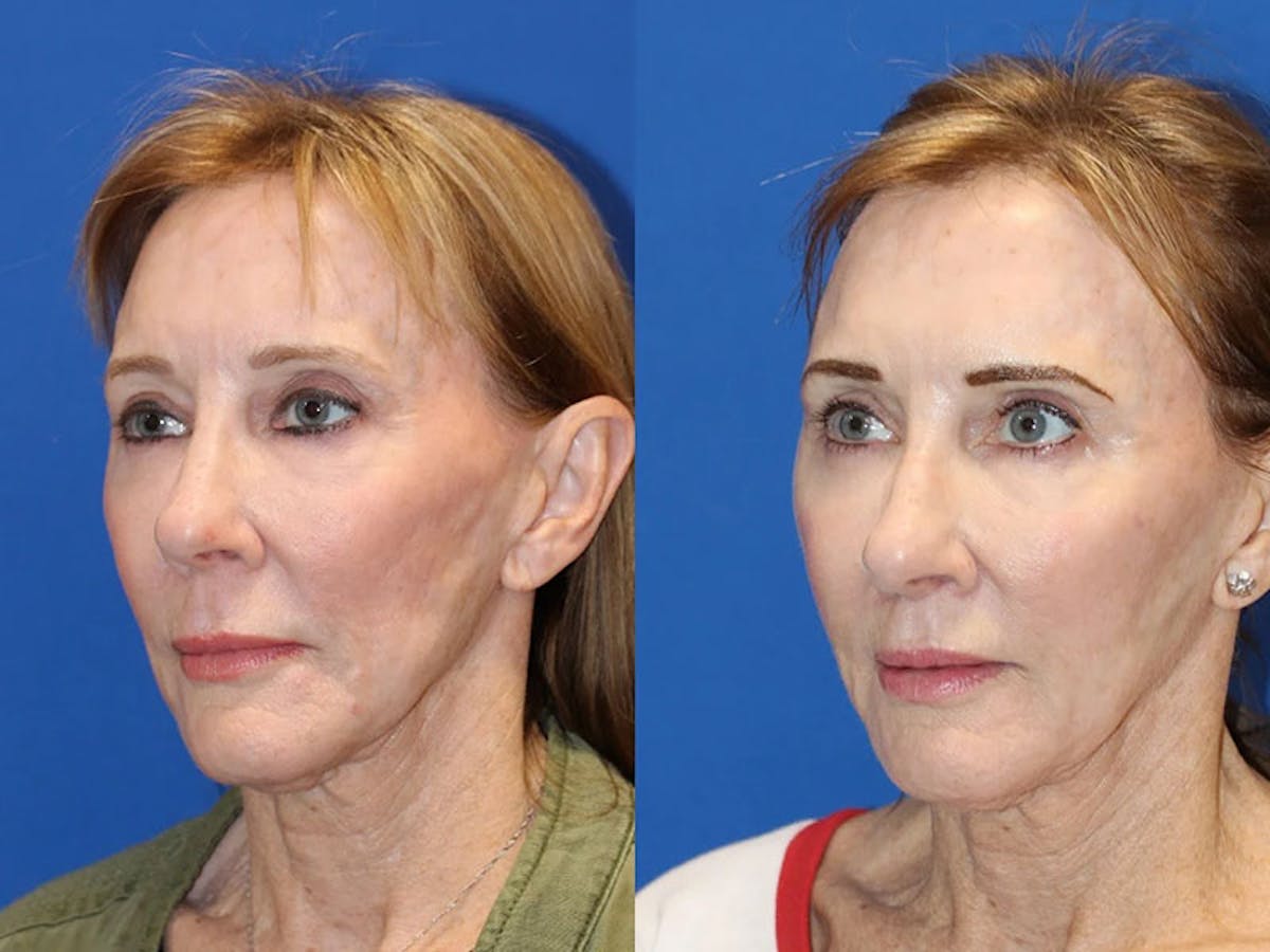 Fat Transfer Before & After Gallery - Patient 71701276 - Image 2