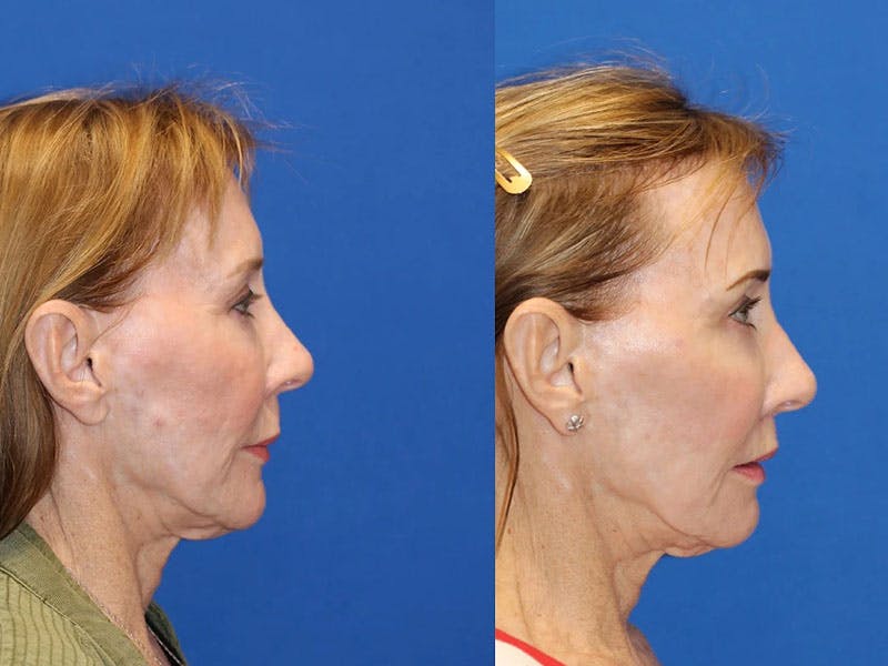 Fat Transfer Before & After Gallery - Patient 71701276 - Image 3
