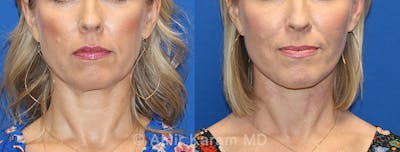 Fat Transfer Before & After Gallery - Patient 91739380 - Image 1