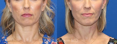 Vertical Restore® / Facial Rejuvenation Before & After Gallery - Patient 71701279 - Image 1