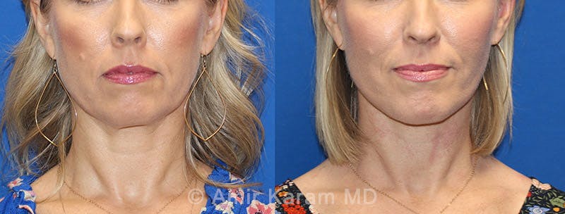 Fat Transfer Before & After Gallery - Patient 91739380 - Image 1