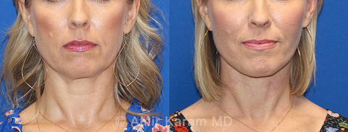 Vertical Restore® / Facial Rejuvenation Before & After Gallery - Patient 71701279 - Image 1