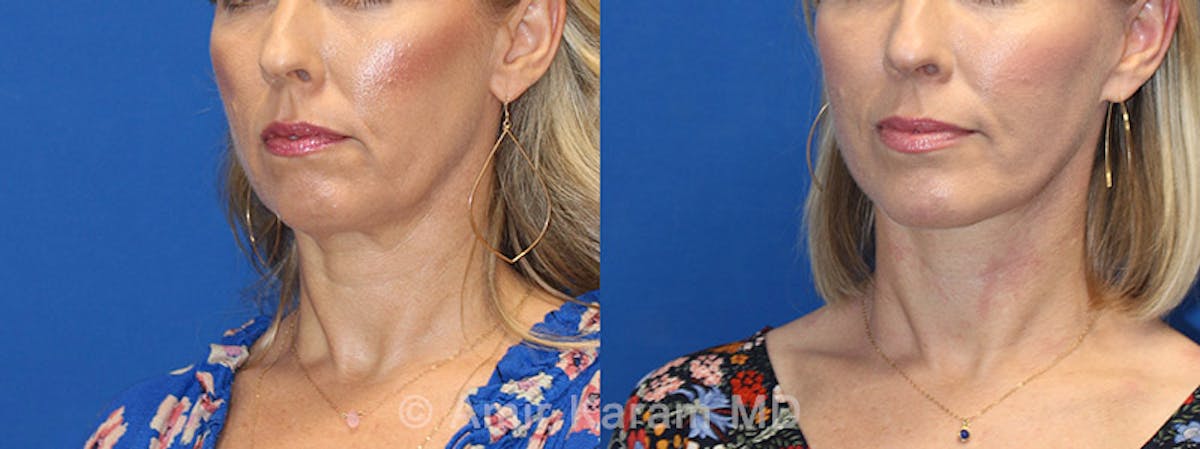 Fat Transfer Before & After Gallery - Patient 91739380 - Image 2