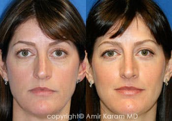 Fat Transfer Before & After Gallery - Patient 71701278 - Image 1