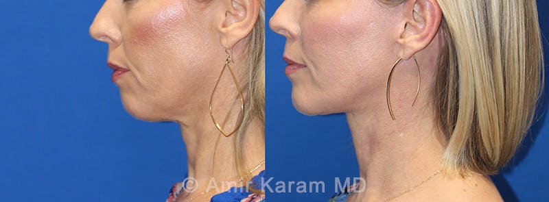 Fat Transfer Before & After Gallery - Patient 91739380 - Image 3