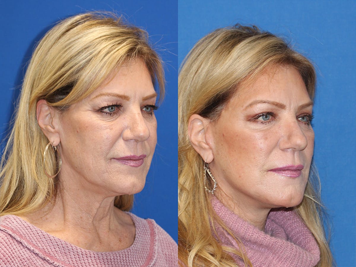 Vertical Restore® / Facial Rejuvenation Before & After Gallery - Patient 71701284 - Image 1